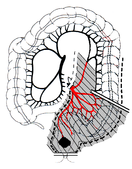 legatura alta dell�arteria mesenterica inferiore